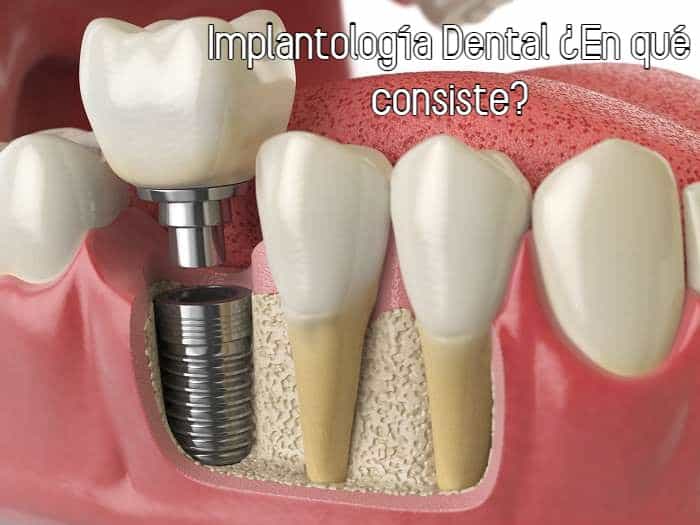 Implantología Dental En qué consiste