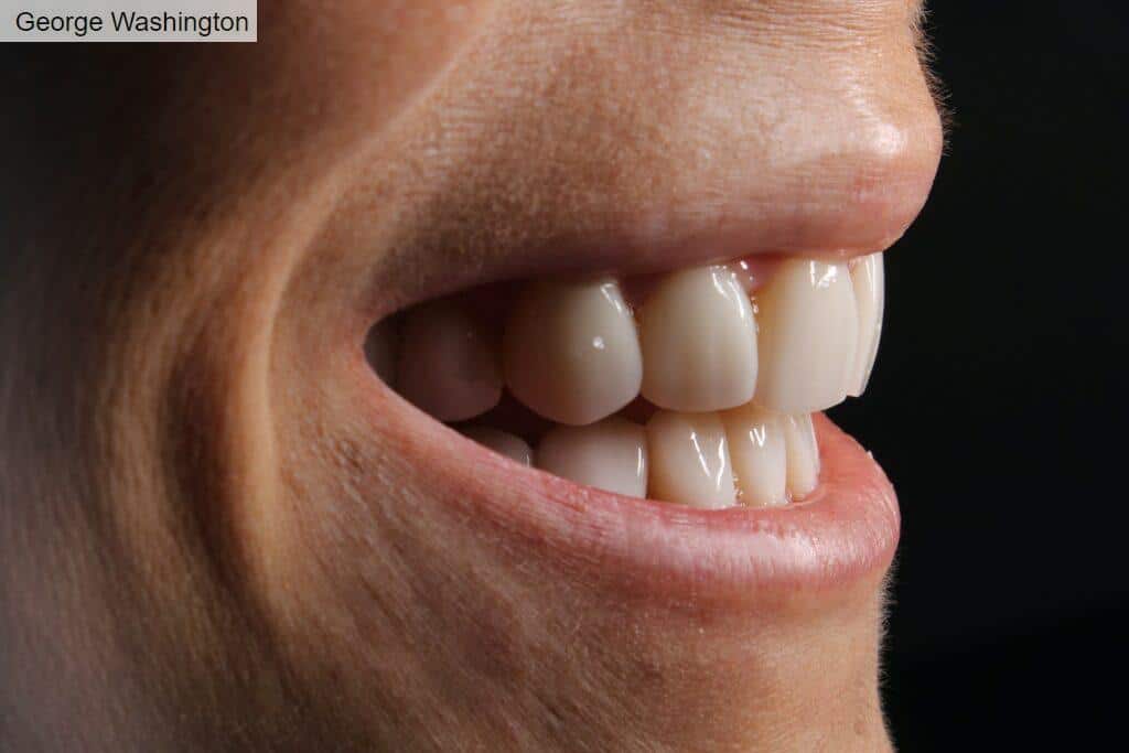 ¿Qué son las carillas dentales?